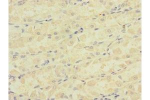 Immunohistochemistry of paraffin-embedded human gastric cancer using ABIN7145065 at dilution of 1:100 (Attractin Antikörper  (AA 84-350))
