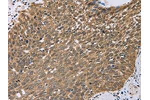 The image on the left is immunohistochemistry of paraffin-embedded Human cervical cancer tissue using ABIN7130557(PCP4 Antibody) at dilution 1/50, on the right is treated with fusion protein. (PCP4 Antikörper)