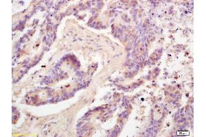 Formalin-fixed and paraffin embedded human colon carcinoma labeled with Rabbit Anti Adiponectin Polyclonal Antibody, Unconjugated (ABIN669051) at 1:200 followed by conjugation to the secondary antibody and DAB staining