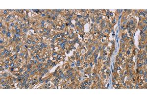 Immunohistochemistry of paraffin-embedded Human esophagus cancer using BSG Polyclonal Antibody at dilution of 1:60 (CD147 Antikörper)
