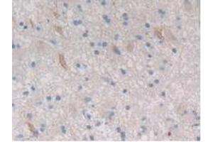 IHC-P analysis of Human Glioma Tissue, with DAB staining. (CTRB1 Antikörper  (AA 34-261))