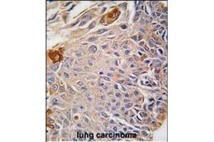 Formalin-fixed and paraffin-embedded human lung carcinoma reacted with RMND5B antibody (C-term), which was peroxidase-conjugated to the secondary antibody, followed by DAB staining. (RMND5B Antikörper  (C-Term))