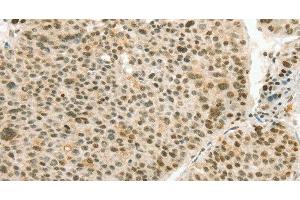 Immunohistochemistry of paraffin-embedded Human liver cancer using ANGPT4 Polyclonal Antibody at dilution of 1:70 (Angiopoietin 4 Antikörper)