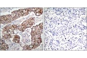 Immunohistochemistry analysis of paraffin-embedded human breast carcinoma, using EGFR (Phospho-Tyr1092) Antibody.