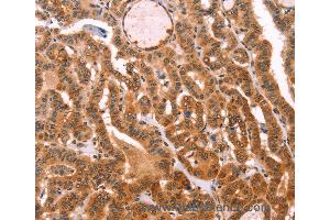 Immunohistochemistry of Human lung cancer using PROS1 Polyclonal Antibody at dilution of 1:40 (PROS1 Antikörper)