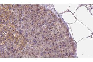 ABIN6273260 at 1/100 staining Human pancreas cancer tissue by IHC-P. (LAPTM4B Antikörper  (Internal Region))