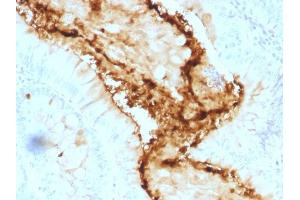 Formalin-fixed, paraffin-embedded human Colon Carcinoma stained with Lewis Y Mouse Monoclonal Antibody (A70-A/A9). (Blood Group Lewis Y Antikörper)