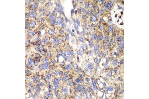 Immunohistochemistry of paraffin-embedded human lung cancer using SPARC antibody (ABIN3022250, ABIN3022251, ABIN1513555 and ABIN6218694) at dilution of 1:100 (40x lens). (SPARC Antikörper  (AA 18-303))