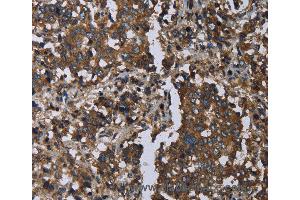 Immunohistochemistry of Human liver cancer using GOLGA2 Polyclonal Antibody at dilution of 1:60
