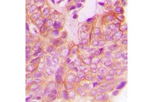 Immunohistochemical analysis of FRK staining in human breast cancer formalin fixed paraffin embedded tissue section.