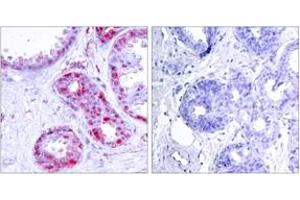 Immunohistochemistry analysis of paraffin-embedded human breast carcinoma, using c-Jun (Phospho-Ser243) Antibody. (C-JUN Antikörper  (pSer243))