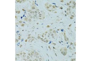 Immunohistochemistry of paraffin-embedded human breast cancer using RCC1 antibody (ABIN5973761) at dilution of 1/100 (40x lens). (RCC1 Antikörper)