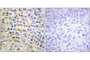 Immunohistochemistry analysis of paraffin-embedded human breast carcinoma tissue, using EGFR (Ab-678) Antibody.
