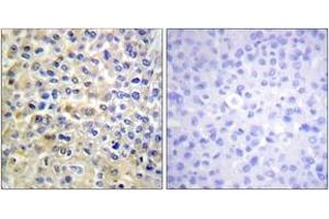 Immunohistochemistry analysis of paraffin-embedded human breast carcinoma tissue, using EGFR (Ab-678) Antibody. (EGFR Antikörper  (AA 651-700))