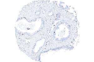 Prostatic adenocarcinoma Gleason 336 with strong MCM3 positivity of few tumor cells (MCM3 Antikörper)