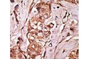 IHC analysis of FFPE human breast carcinoma tissue stained with the LRRK2 antibody (LRRK2 Antikörper  (AA 931-962))