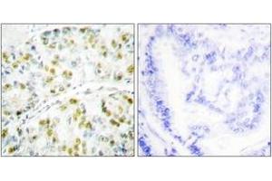 Immunohistochemistry analysis of paraffin-embedded human lung carcinoma tissue, using Ataxin 1 (Ab-776) Antibody. (Ataxin 1 Antikörper  (AA 742-791))