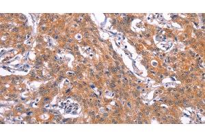 Immunohistochemistry of paraffin-embedded Human gastic cancer using CD269 Polyclonal Antibody at dilution of 1:30 (BCMA Antikörper)
