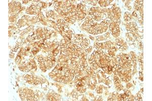 Formalin-fixed, paraffin-embedded human Renal Cell Carcinoma stained with EpCAM Rabbit Polyclonal Antibody. (EpCAM Antikörper)