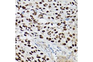 Immunohistochemistry of paraffin-embedded human lung squamous carcinoma tissue using p63 Rabbit mAb (ABIN7271099) at dilution of 1:100 (40x lens). (p63 Antikörper)