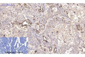 Immunohistochemical analysis of paraffin-embedded human lung cancer tissue.