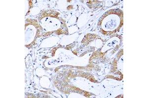 Immunohistochemical analysis of BCR staining in human colon cancer formalin fixed paraffin embedded tissue section. (BCR Antikörper  (N-Term))