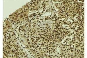 ABIN6278743 at 1/100 staining Human breast cancer tissue by IHC-P.