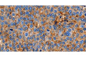 Immunohistochemistry of paraffin-embedded Human esophagus cancer using Claudin 1 Polyclonal Antibody at dilution of 1:150 (Claudin 1 Antikörper)