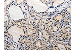 The image on the left is immunohistochemistry of paraffin-embedded Human thyroid cancer tissue using ABIN7189663(ADAMTS6 Antibody) at dilution 1/20, on the right is treated with synthetic peptide. (ADAMTS6 Antikörper)