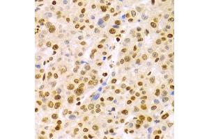 Immunohistochemistry of paraffin-embedded human liver cancer using DKC1 Antibody (ABIN5970956) at dilution of 1/100 (40x lens). (DKC1 Antikörper)