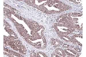 IHC-P Image Immunohistochemical analysis of paraffin-embedded Lung Ad Cancer PC14 xenograft, using PCCB, antibody at 1:100 dilution. (PCCB Antikörper  (Center))