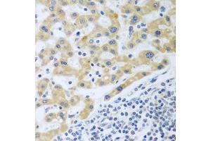 Immunohistochemistry of paraffin-embedded human liver cancer using SHBG antibody. (SHBG Antikörper)