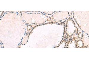 Immunohistochemistry of paraffin-embedded Human thyroid cancer tissue using RNF13 Polyclonal Antibody at dilution of 1:60(x200) (RNF13 Antikörper)