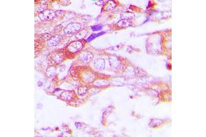 Immunohistochemical analysis of Cytochrome P450 2A13 staining in human lung cancer formalin fixed paraffin embedded tissue section. (CYP2A13 Antikörper  (Center))
