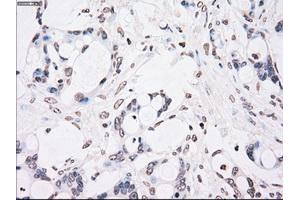 Immunohistochemical staining of paraffin-embedded Adenocarcinoma of colon tissue using anti-CHEK2mouse monoclonal antibody. (CHEK2 Antikörper)