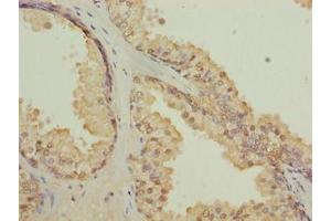 Immunohistochemistry of paraffin-embedded human prostate cancer using ABIN7147501 at dilution of 1:100 (CGGBP1 Antikörper  (AA 1-167))