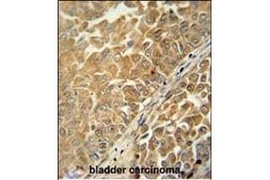 C antibody (Center) (ABIN654959 and ABIN2844598) immunohistochemistry analysis in formalin fixed and paraffin embedded human bladder carcinoma followed by peroxidase conjugation of the secondary antibody and DAB staining. (C18ORF25 Antikörper  (AA 163-191))