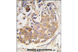 Formalin-fixed and paraffin-embedded human breast carcinoma tissue reacted with COL9A1 antibody , which was peroxidase-conjugated to the secondary antibody, followed by DAB staining. (COL9A1 Antikörper  (AA 428-456))