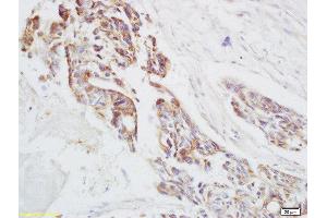 Formalin-fixed and paraffin embedded human rectal carcinoma labeled with Anti-Ensconsin Polyclonal Antibody, Unconjugated  at 1:200 followed by conjugation to the secondary antibody and DAB staining (MAP7 Antikörper  (AA 151-250))