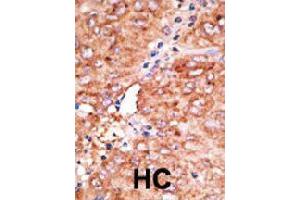 Formalin-fixed and paraffin-embedded human hepatocellular carcinoma tissue reacted with CCBP2 polyclonal antibody  , which was peroxidase-conjugated to the secondary antibody, followed by AEC staining. (CCBP2 Antikörper  (C-Term))