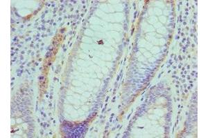 Immunohistochemistry of paraffin-embedded human colon cancer using ABIN7143460 at dilution of 1: 100 (ARFGAP1 Antikörper  (AA 1-220))