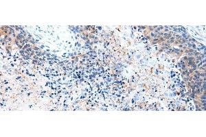 Immunohistochemistry of paraffin-embedded Human esophagus cancer tissue using COLEC12 Polyclonal Antibody at dilution 1:40 (COLEC12 Antikörper)