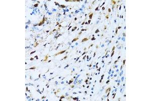 Immunohistochemistry of paraffin-embedded human gastric cancer using XRCC4 antibody (ABIN3022381, ABIN3022382, ABIN3022383 and ABIN6218772) at dilution of 1:100 (40x lens). (XRCC4 Antikörper  (AA 1-336))