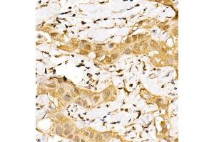 Immunohistochemistry of paraffin-embedded human breast cancer using GPS1 Rabbit pAb (ABIN6127934, ABIN6141361, ABIN6141362 and ABIN6222653) at dilution of 1:250 (40x lens). (GPS1 Antikörper  (AA 258-527))