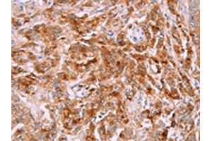 The image on the left is immunohistochemistry of paraffin-embedded Human prostate cancer tissue using ABIN7191308(LPCAT4 Antibody) at dilution 1/15, on the right is treated with synthetic peptide. (LPCAT4 Antikörper)