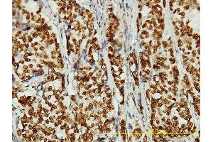 Immunoperoxidase of monoclonal antibody to KIAA0056 on formalin-fixed paraffin-embedded human breast cancer tissue. (NCAPD3 Antikörper  (AA 1-341))