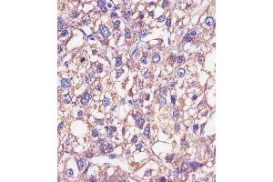 (ABIN652875 and ABIN2842566) staining HP in human epatocarcinoma sections by Immunohistochemistry (IHC-P - paraformaldehyde-fixed, paraffin-embedded sections). (Haptoglobin Antikörper  (Center))