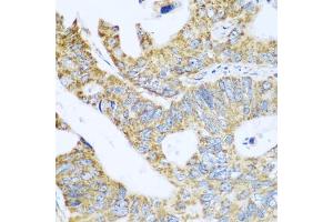 Immunohistochemistry of paraffin-embedded human colon carcinoma using GLUD1 antibody (ABIN5975614) at dilution of 1/100 (40x lens). (GLUD1 Antikörper)