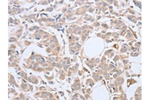 The image on the left is immunohistochemistry of paraffin-embedded Human breast cancer tissue using ABIN7128138(ABHD5 Antibody) at dilution 1/10, on the right is treated with fusion protein. (ABHD5 Antikörper)