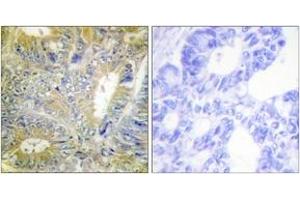 Immunohistochemistry analysis of paraffin-embedded human colon carcinoma tissue, using Desmin (Ab-60) Antibody. (Desmin Antikörper  (AA 26-75))